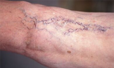 hanketan barizeak tratatzeko metodoak