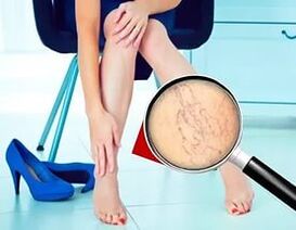 Sintomak barizearen izaera eta etaparen araberakoak dira